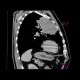 Lung carcinoma, metastasis: CT - Computed tomography